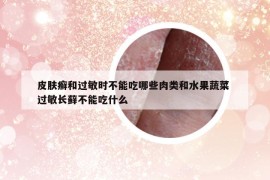 皮肤癣和过敏时不能吃哪些肉类和水果蔬菜 过敏长藓不能吃什么