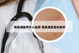 银屑病指甲坏人贴吧 银屑病患者的指甲