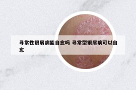 寻常性银屑病能自愈吗 寻常型银屑病可以自愈