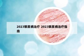 2023银屑病治疗 2023银屑病治疗指南