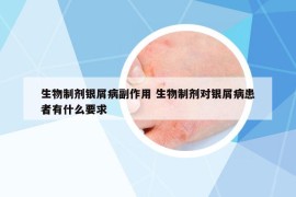 生物制剂银屑病副作用 生物制剂对银屑病患者有什么要求