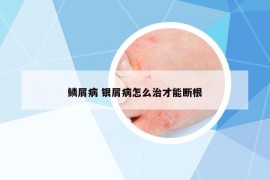 鳞屑病 银屑病怎么治才能断根