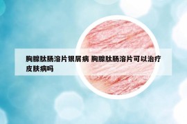 胸腺肽肠溶片银屑病 胸腺肽肠溶片可以治疗皮肤病吗