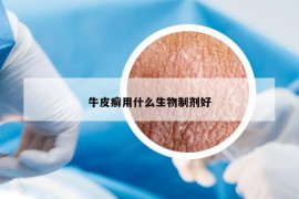 牛皮癣用什么生物制剂好