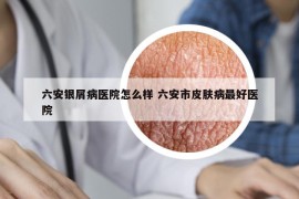 六安银屑病医院怎么样 六安市皮肤病最好医院