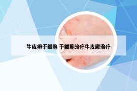 牛皮癣干细胞 干细胞治疗牛皮廨治疗