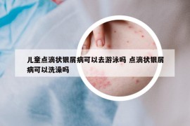 儿童点滴状银屑病可以去游泳吗 点滴状银屑病可以洗澡吗