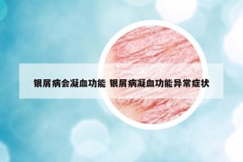 银屑病会凝血功能 银屑病凝血功能异常症状