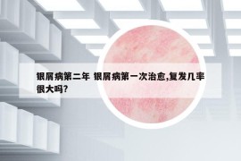 银屑病第二年 银屑病第一次治愈,复发几率很大吗?