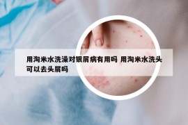 用淘米水洗澡对银屑病有用吗 用淘米水洗头可以去头屑吗