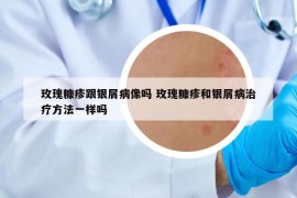 玫瑰糠疹跟银屑病像吗 玫瑰糠疹和银屑病治疗方法一样吗