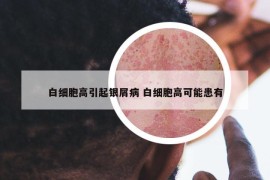 白细胞高引起银屑病 白细胞高可能患有