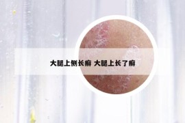 大腿上侧长癣 大腿上长了癣