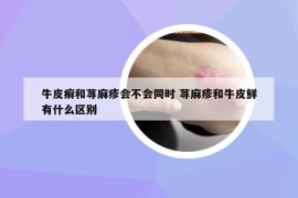 牛皮癣和荨麻疹会不会同时 荨麻疹和牛皮鲜有什么区别