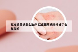 红皮银屑病怎么治疗 红皮银屑病治疗好了会复发吗