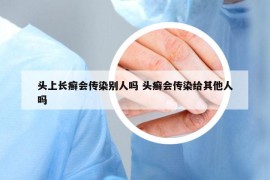 头上长癣会传染别人吗 头癣会传染给其他人吗