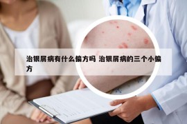 治银屑病有什么偏方吗 治银屑病的三个小偏方