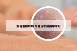 烟台治银屑病 烟台治银屑病哪家好