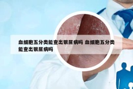 血细胞五分类能查出银屑病吗 血细胞五分类能查出银屑病吗