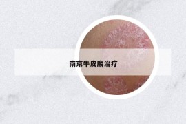 南京牛皮廨治疗