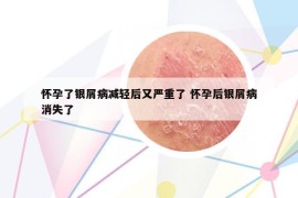 怀孕了银屑病减轻后又严重了 怀孕后银屑病消失了