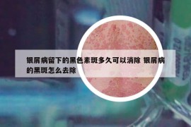 银屑病留下的黑色素斑多久可以消除 银屑病的黑斑怎么去除