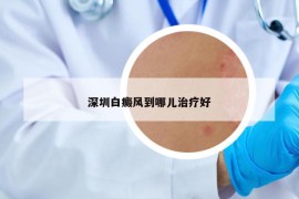 深圳白癜风到哪儿治疗好