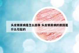 头皮银屑病是怎么回事 头皮银屑病的原因是什么引起的