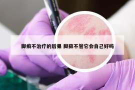 脚癣不治疗的后果 脚藓不管它会自己好吗