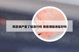 银屑病严重了输液行吗 银屑病输液能好吗