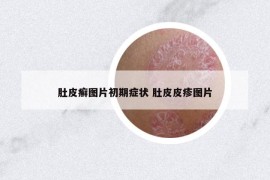 肚皮癣图片初期症状 肚皮皮疹图片