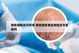 银屑病髋关节积液 银屑病患者能做髋关节置换吗