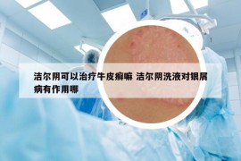 洁尔阴可以治疗牛皮癣嘛 洁尔阴洗液对银屑病有作用哪