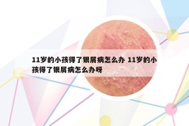 11岁的小孩得了银屑病怎么办 11岁的小孩得了银屑病怎么办呀