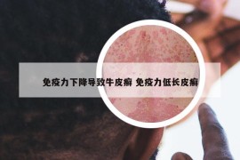 免疫力下降导致牛皮癣 免疫力低长皮癣