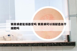 银屑病者能捐器官吗 银屑病可以捐献造血干细胞吗