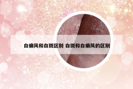 白癞风和白斑区别 白斑和白癞风的区别