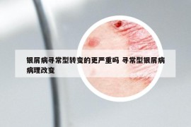 银屑病寻常型转变的更严重吗 寻常型银屑病病理改变