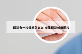 后背有一片像癣怎么办 女生后背长癣图片