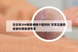 空总和304银屑病哪个医院好 空军总医院皮肤科银屑病专家