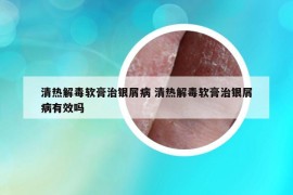 清热解毒软膏治银屑病 清热解毒软膏治银屑病有效吗