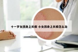 十一岁女孩身上长癣 小女孩身上长癣怎么治