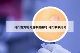 马氏古方乳膏治牛皮癣吗 马氏中草药膏