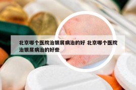 北京哪个医院治银屑病治的好 北京哪个医院治银屑病治的好些