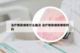 治疗银屑病有什么偏法 治疗银屑病有哪些好药