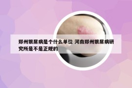 郑州银屑病是个什么单位 河南郑州银屑病研究所是不是正规的