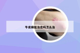 牛皮癣能治愈吗怎么治