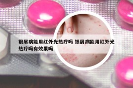 银屑病能用红外光热疗吗 银屑病能用红外光热疗吗有效果吗