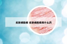 皮肤病股癣 皮肤病股癣用什么药