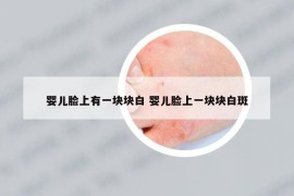 婴儿脸上有一块块白 婴儿脸上一块块白斑